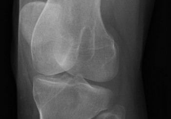 L’Artrosi – Il ginocchio